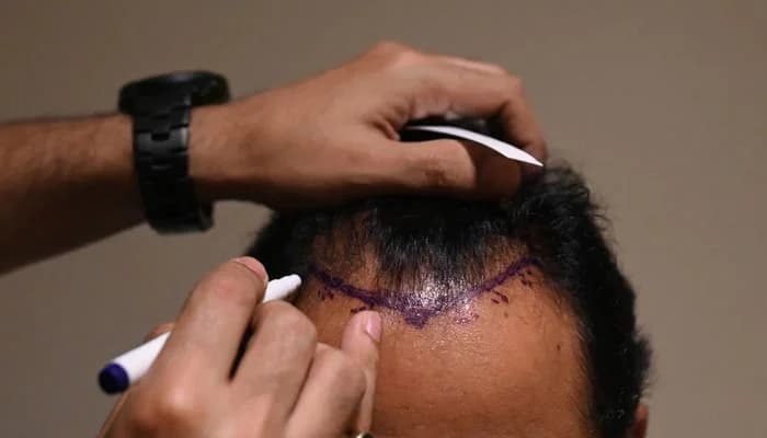 Haartransplantation türkei für Männer: Eine Lösung für Glatzenbildung