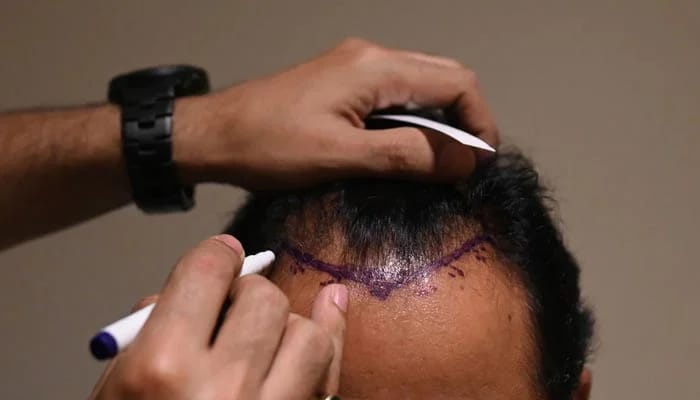 Haartransplantation türkei für Männer: Eine Lösung für Glatzenbildung